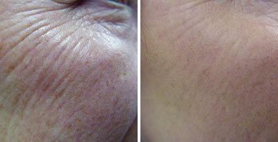 Como prevenir o envelhecimento da pele